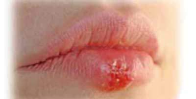 Prevenir y tratar el herpes labial